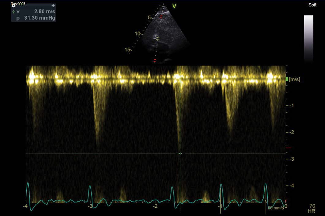 A Clinically And Echocardiographically Demonstrable Dynamic Left